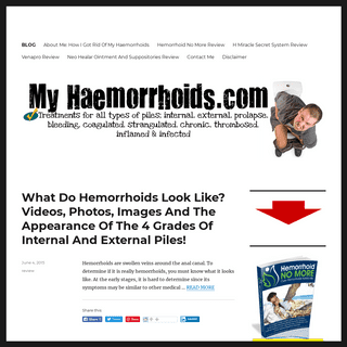 Treatments, Tips, Tricks, Products And Home Remedies To Get Rid Of Hemorrhoids (Piles) Fast – Best Home Treatments And Holistic 