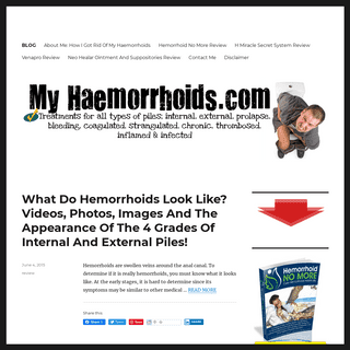 Treatments, Tips, Tricks, Products And Home Remedies To Get Rid Of Hemorrhoids (Piles) Fast â€“ Best Home Treatments And Holisti